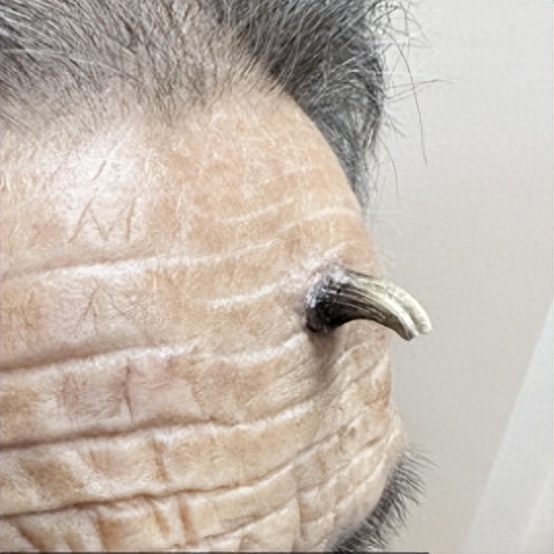 如老年斑,寻常疣,汗孔角化病,毛根鞘瘤等,当然也有一些是早期皮肤癌