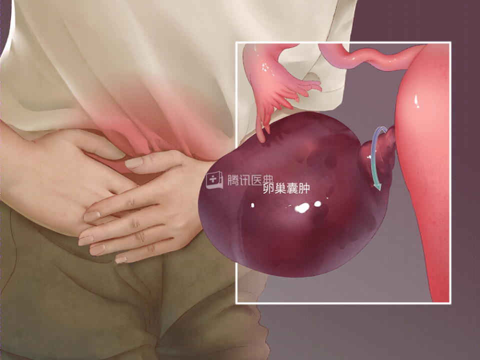 月经没来小肚子却痛,要小心这4种"急腹症"