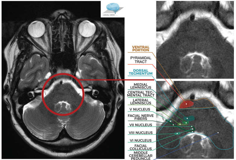 图文并茂:一文掌握脑桥解剖结构及常见综合征