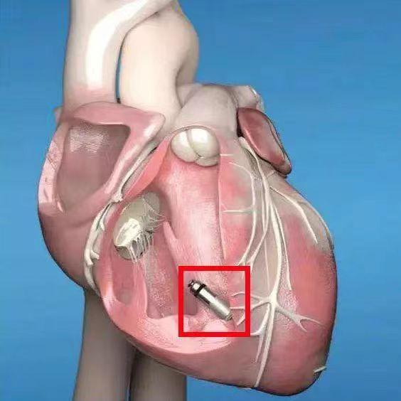 中山市首例双腔无导线起搏器micra av成功植入_腾讯新闻