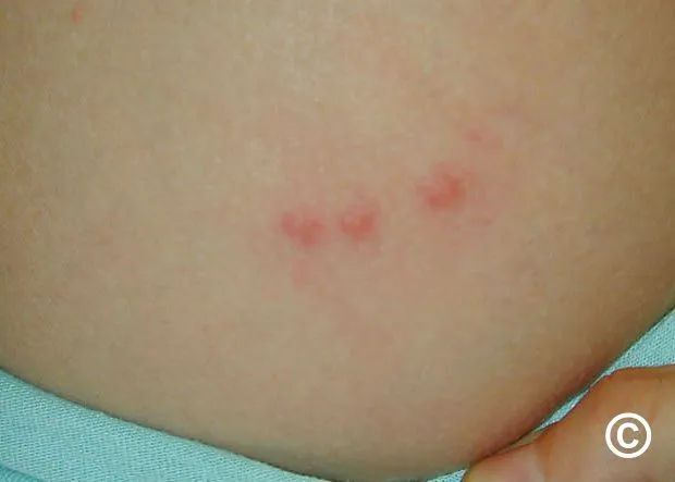 又痛又肿的"火疖子"别硬挤,有效方法在这里