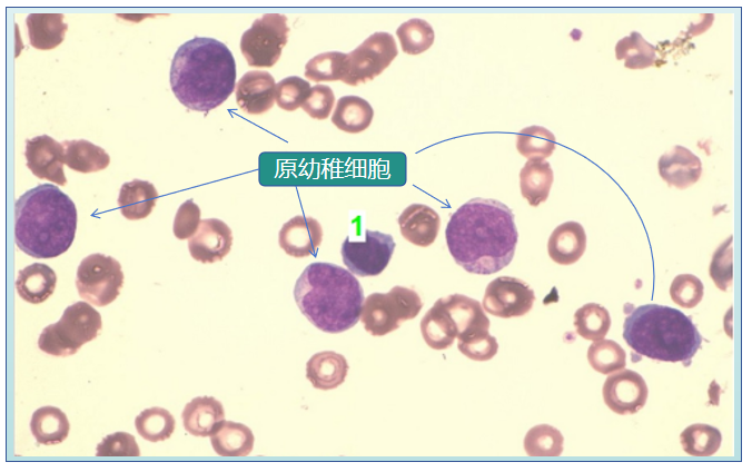 血图片如下图2张↓:白细胞计数(↑),淋巴及单核的百分数均(↑),红细胞