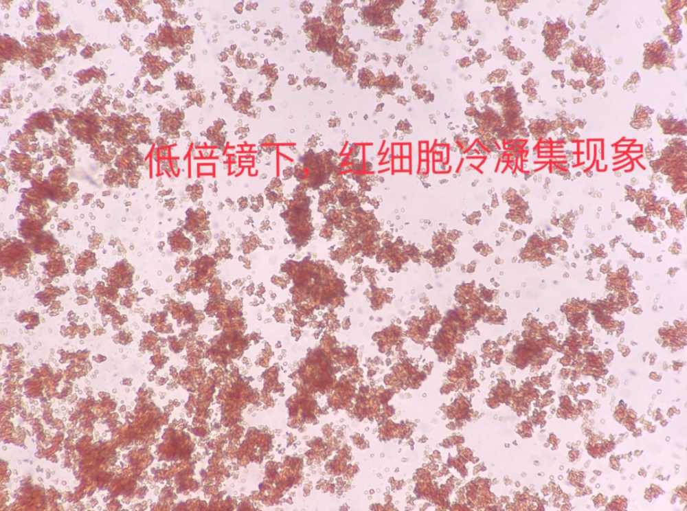 而此患者的"冷凝集",37℃不能纠正,难道血液里存在高效价的冷凝集素?