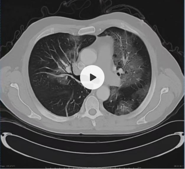 如何在肺 CT 上一眼识别致病菌？ | 读片挑战第 35 弹_腾讯新闻