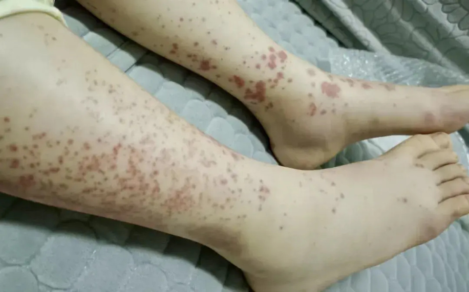 孩子又长皮疹又腹痛,竟是"过敏性紫癜"在捣鬼