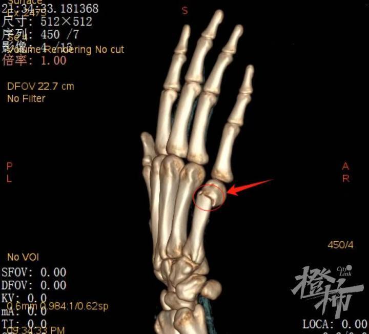 某boxers骨折患者ct三维重建图像 医院供图拳击手骨折,它并不是拳击