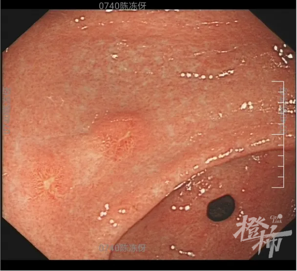 胃癌图片实拍 症状图片