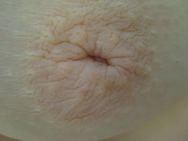 乳头内陷的宝妈也能喂奶,这几个方法亲测好用!