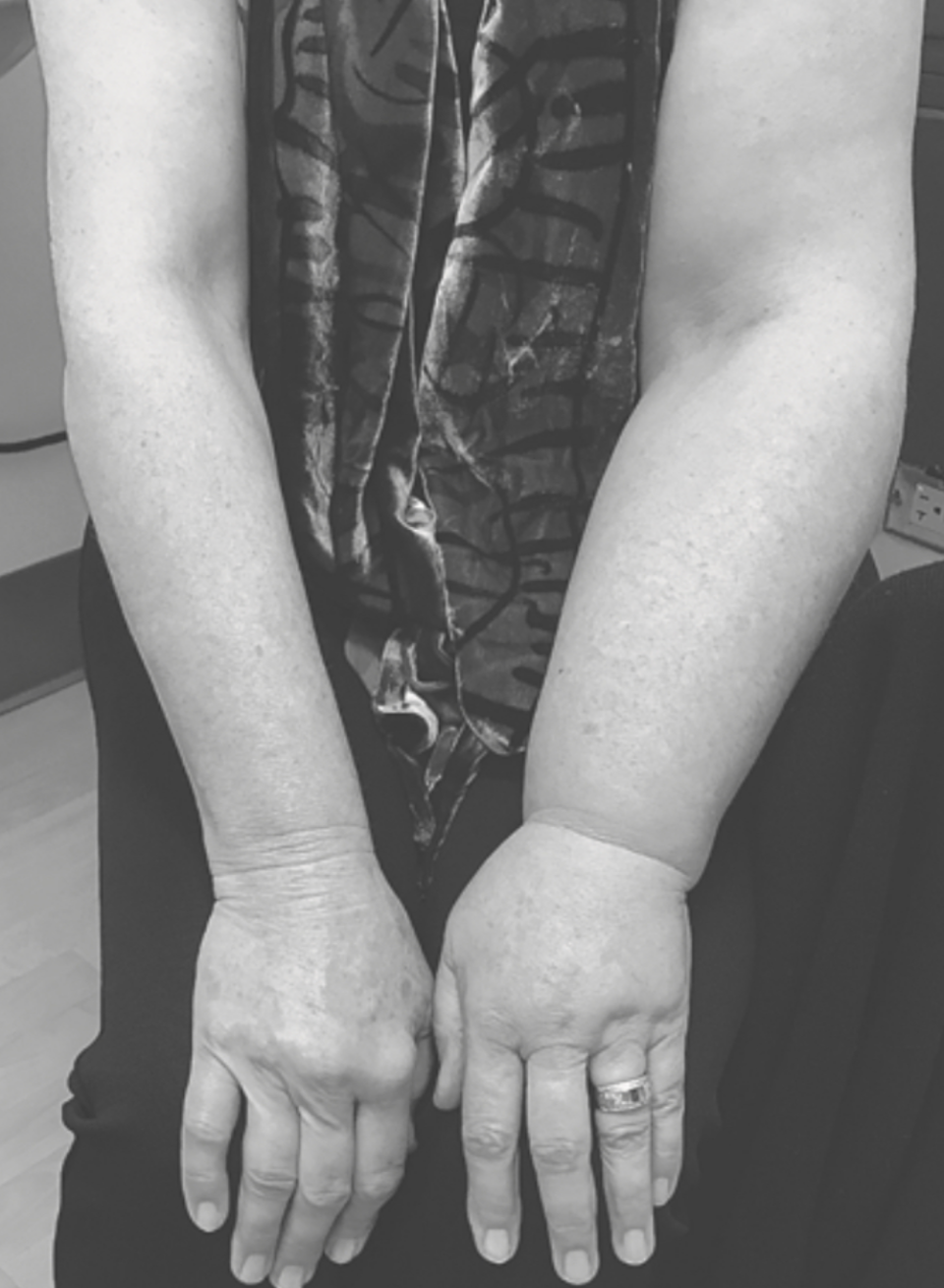 腋窝淋巴结清扫术清扫得越干净越好吗?_腾讯新闻