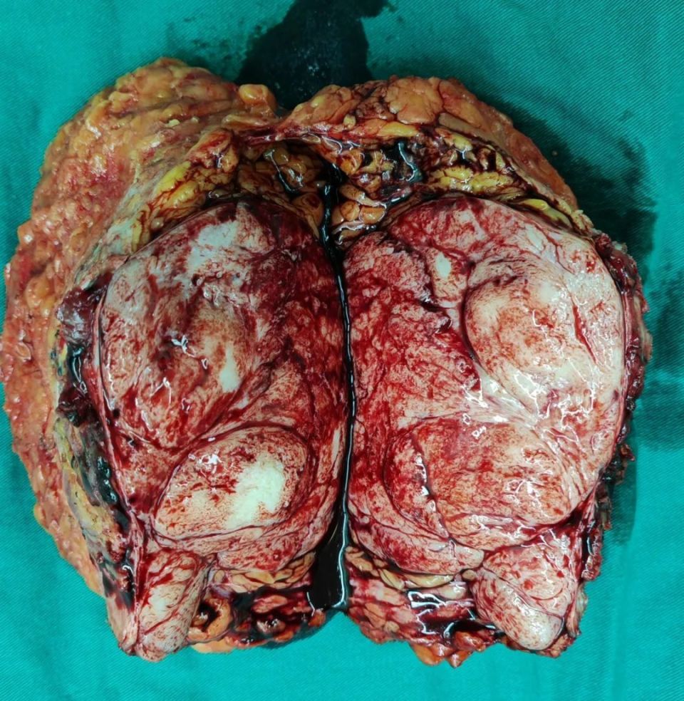 别大意,可能是肿瘤