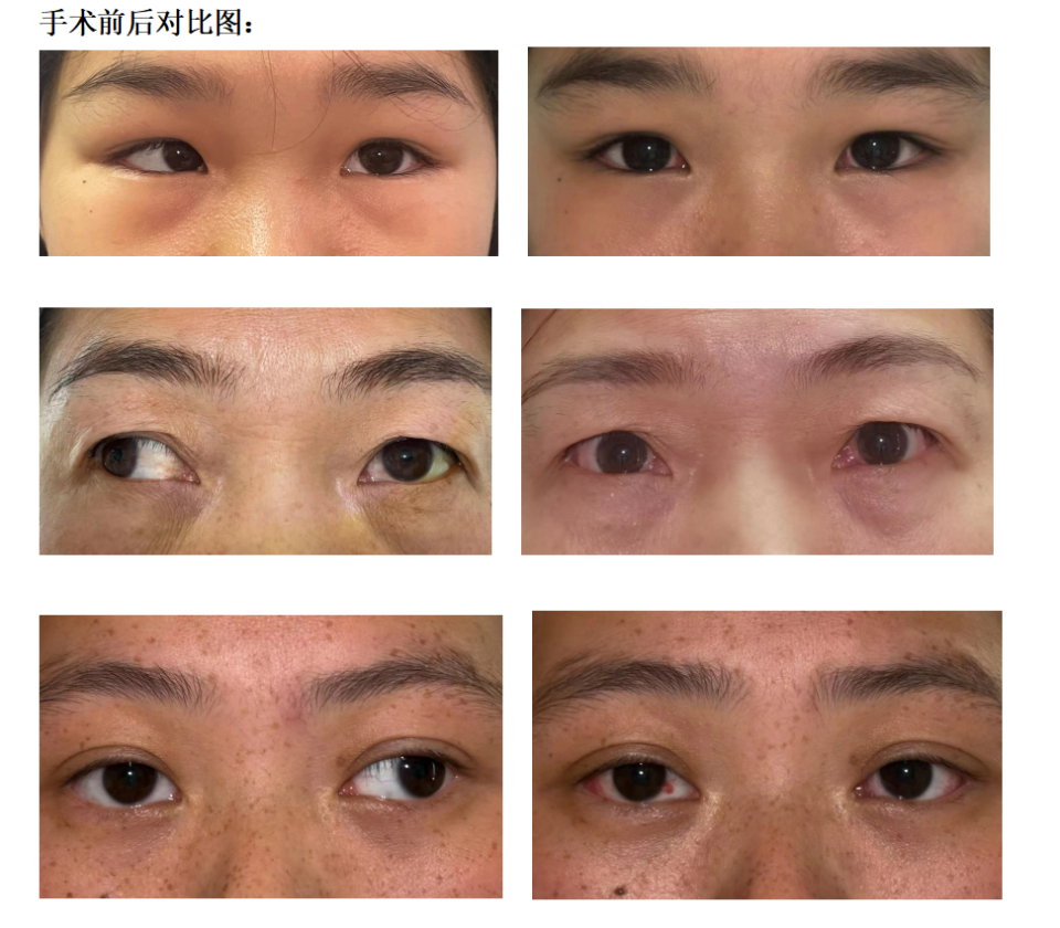 斜视影响的仅仅是颜值吗?