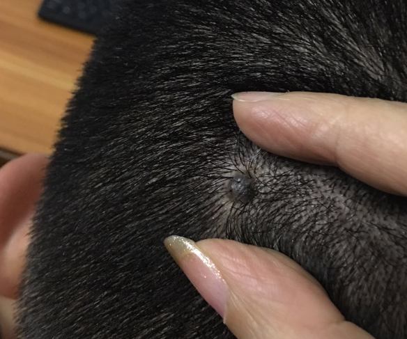 身上长红痣,是夺命"肝癌痣"?痣上长毛,说明癌细胞"已激活"?早知早好