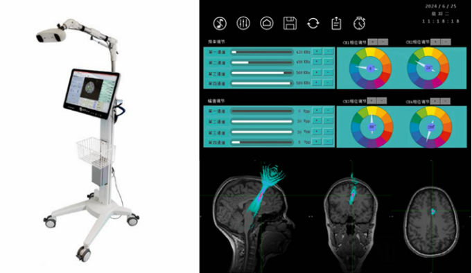 什么是等离子治疗仪北卓医疗：构筑“一体两翼”跨模态智联闭环生态，占据中国神经科学数智化浪潮先发身位_https://www.jmylbn.com_新闻资讯_第7张