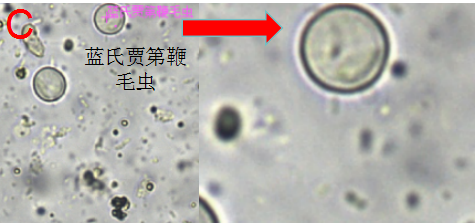 粪便中的这种寄生虫,你见过吗?——迪斯帕内阿米巴