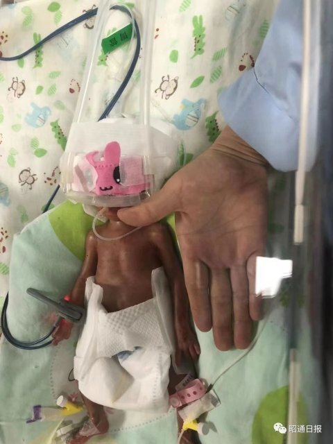 1.5斤!昭通这名超早产女婴,创造了一个奇迹_腾讯新闻