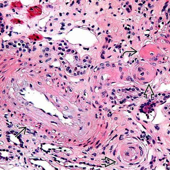 肾脏病理丨血栓性微血管病简介