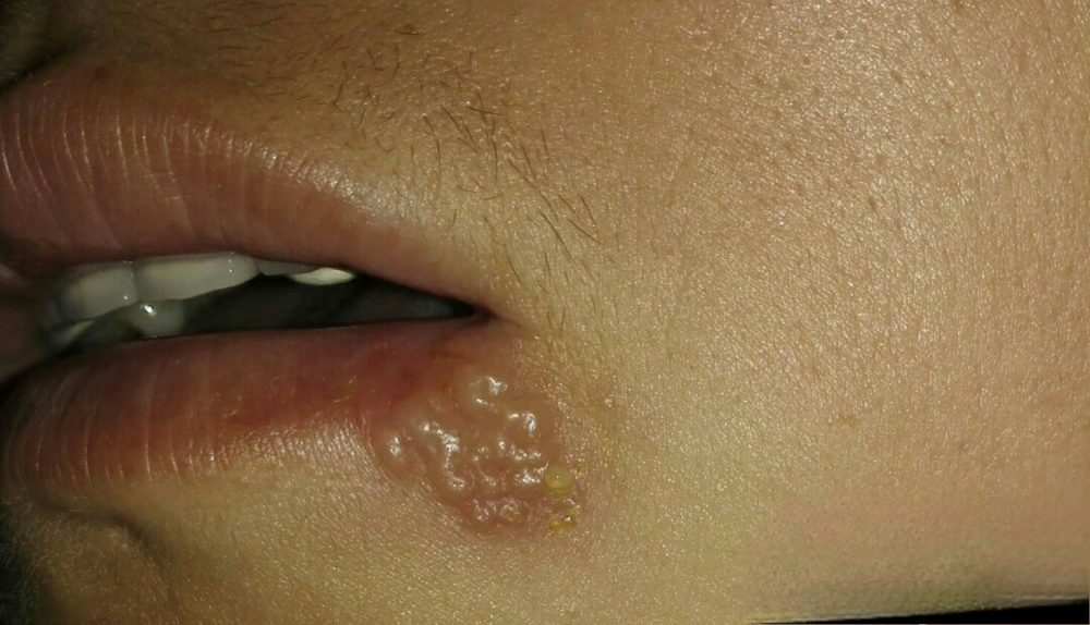 嘴角疱疹怎么治疗好得快?