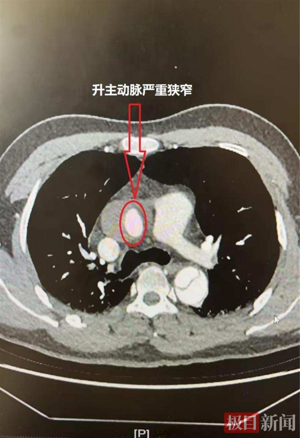 男子深夜突发主动脉夹层命悬一线,医院紧急开辟绿色通道打通"生命线"