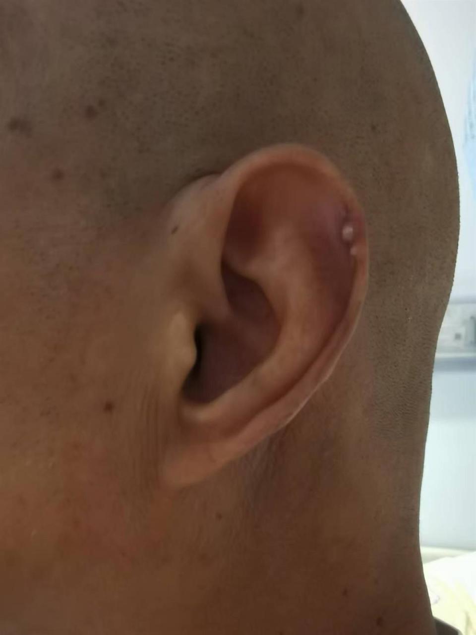 酒龄40年,男子耳朵长出"小珍珠"