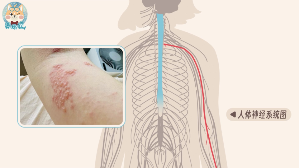 带状疱疹位置图片