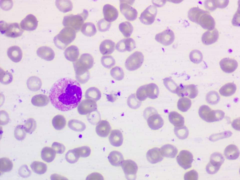 图1 血常规分析结果血涂片镜检:镜下可见白细胞明显减少,多个视野不