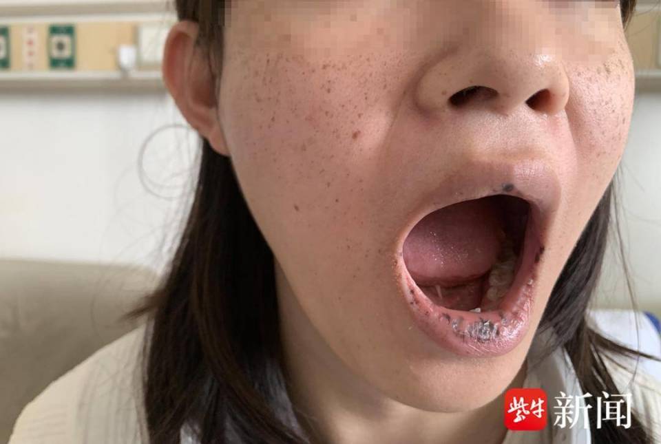 "今天做了一台手术,16岁的小女孩,因发现口唇黑斑去皮肤美容时,医生