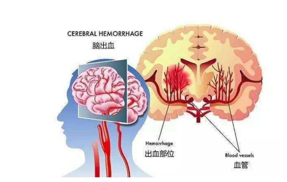 谈"虎"色变的脑中风---"脑溢血"