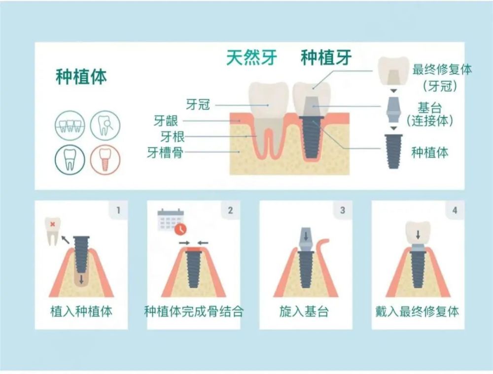 "一口牙,一套房"的时代将彻底结束——种植牙集采政策落地_腾讯新闻