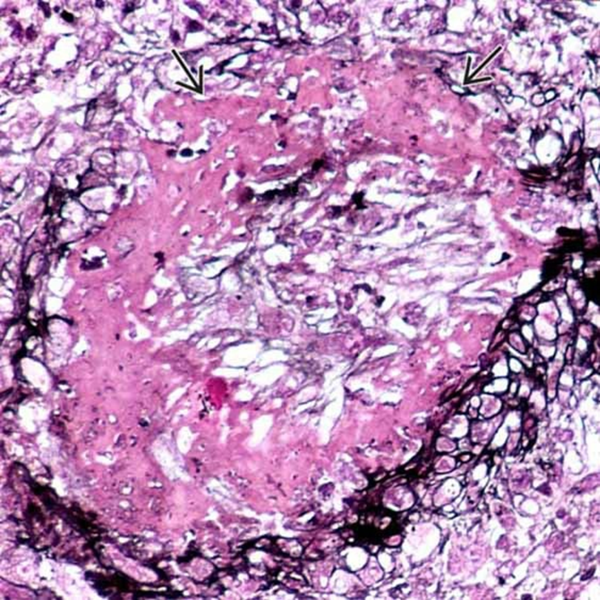 环状纤维蛋白样坏死肾脏小叶间动脉三色染色切片显示环状纤维蛋白样