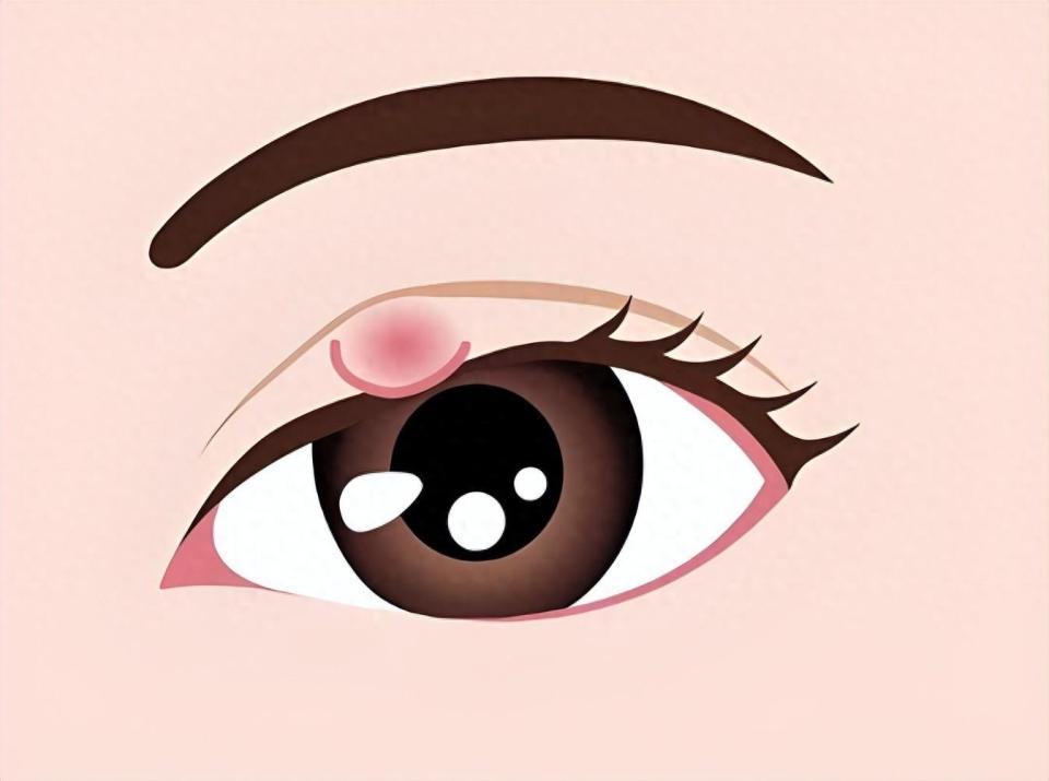 麦粒肿,干眼症正困扰当代打工人!正确的应对之法在这里