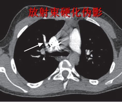 肺动脉 CTA 不会看？这篇教你轻松诊断肺栓塞！_腾讯新闻