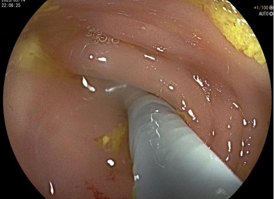 治疗阑尾炎,从微创到无创-腾讯新闻