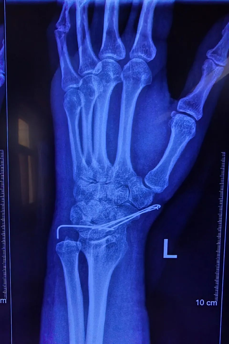 延安市人民医院骨科四病区采用"腕关节镜技术"成功治疗40年陈旧性舟状