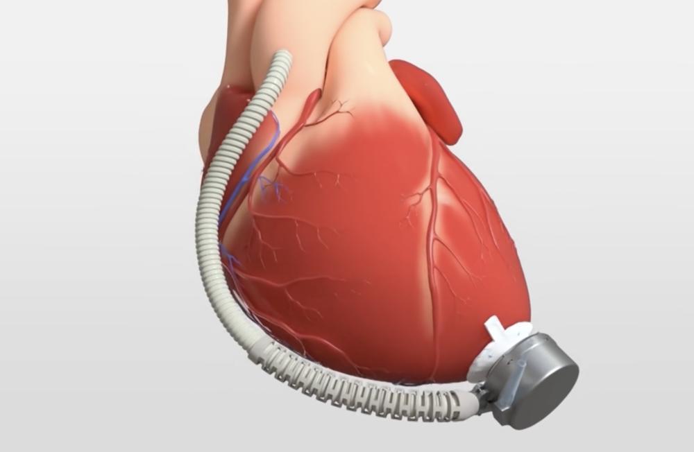 等不了心脏移植,就用人工心脏_腾讯新闻