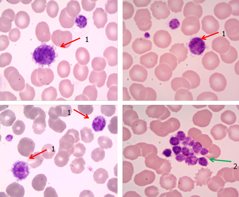 血小板异常 小蓝斑,引出罕见遗传病may-hegglin畸形_腾讯新闻