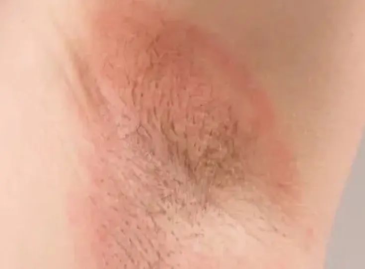 腋下发黑,暗沉,可能是身体发出的疾病信号!快自查