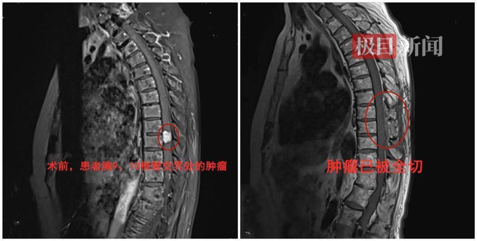脊椎里长瘤的症状图片图片