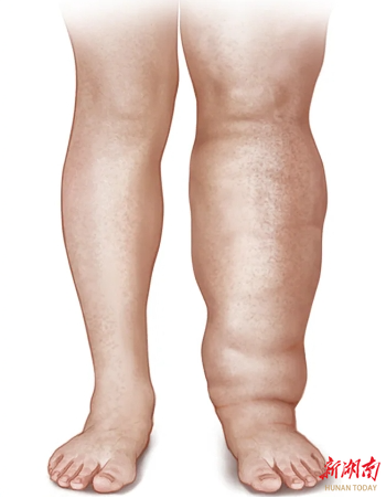 淋巴水肿先别慌居家妙方帮您忙