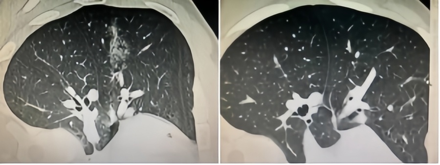微波针是什么体检发现肺磨玻璃结节，只能随访手术二选一？“超微创”的微波消融，了解一下_https://www.jmylbn.com_新闻资讯_第3张
