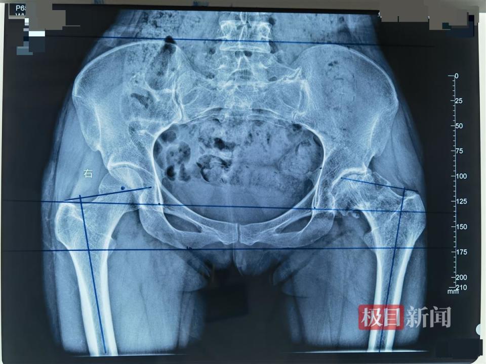 女子股骨头坏死多年,她在协和车谷院区换了髋关节,两个月后重返健身房