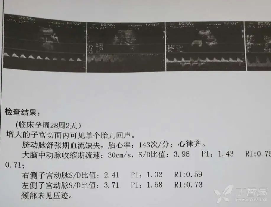 孕 28+2 周血压升高 4 月！这背后隐藏着怎样的秘密？
