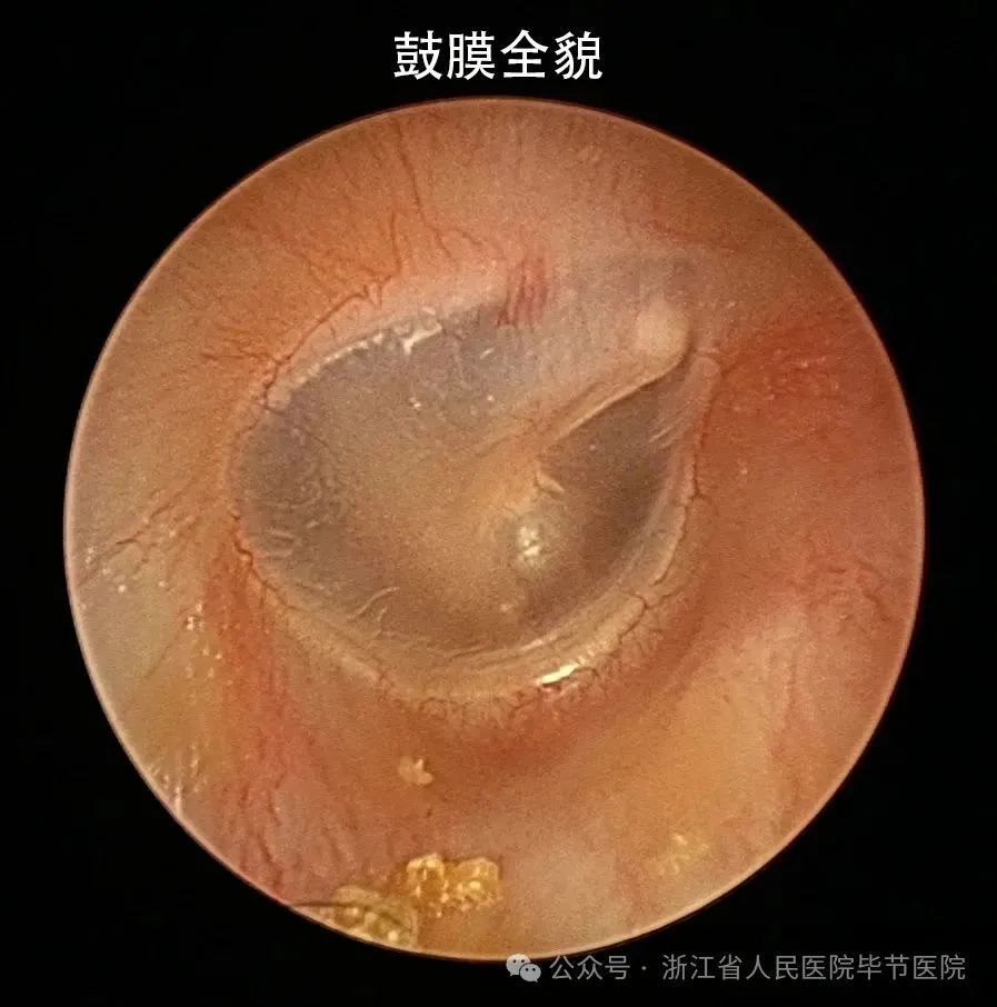 夹层法因对移植物的固定较好,可以使鼓膜的形态和鼓环的原有位置得到