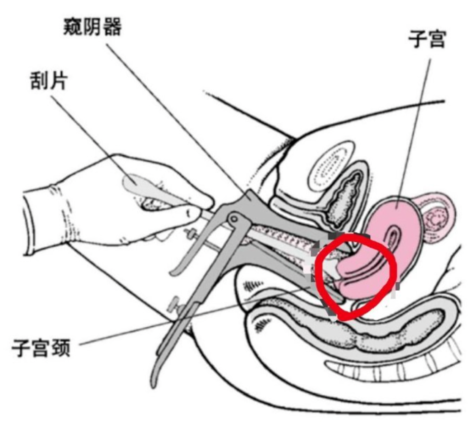 鸭嘴钳妇科检查图片