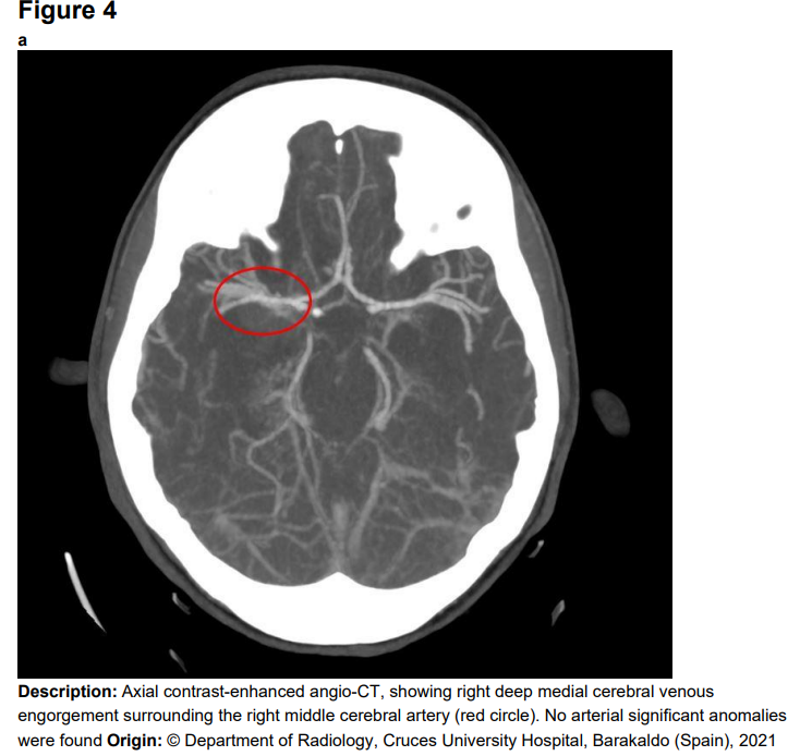 这例双侧颞叶出血伴蛛网膜下腔出血,病因出乎意料