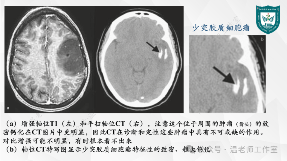 中枢神经系统的病例影像:脑肿瘤