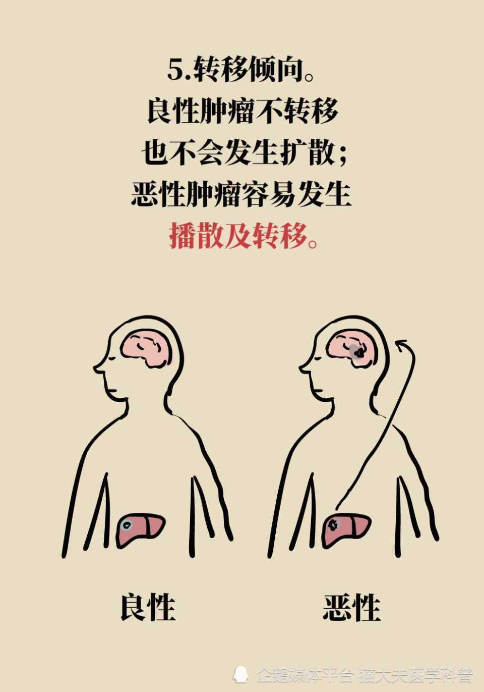 为什么有的肿瘤是良性,有的就是恶性?6个特征可区分