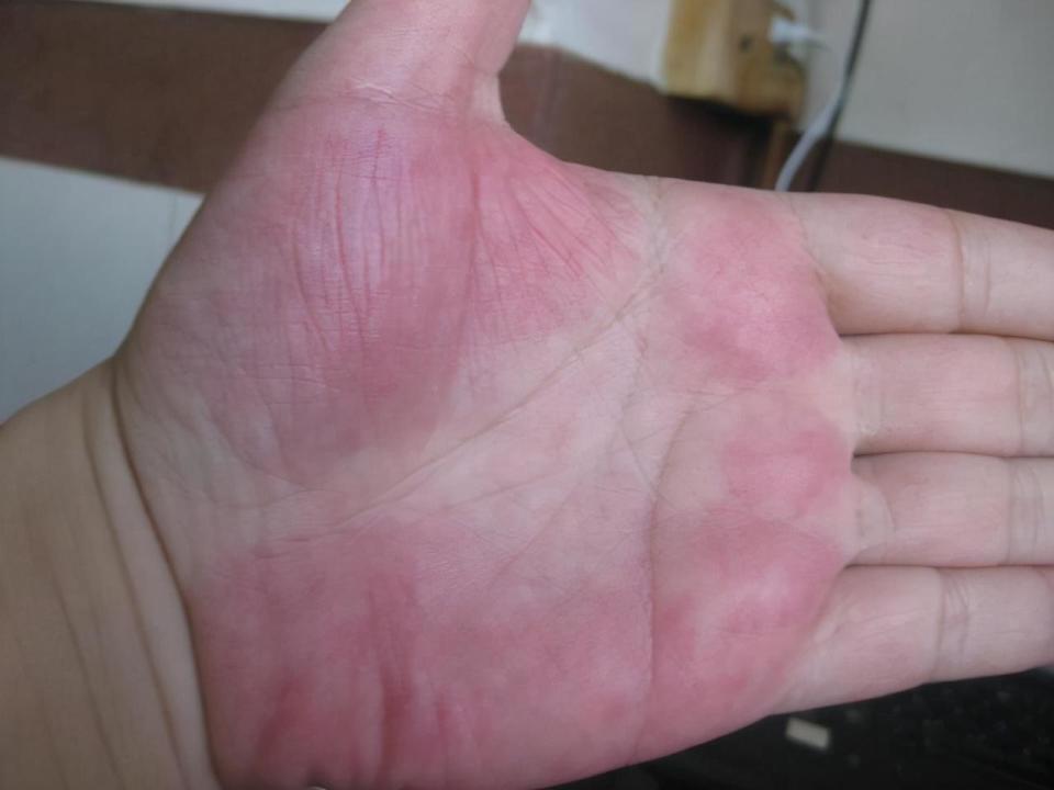 手部出现的4种情况,已经在暗示癌症的来临