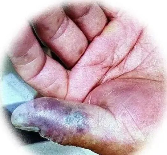男子吃完小龙虾险截指!医生紧急提醒