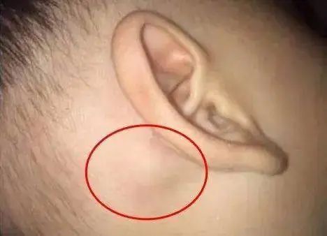 耳后有时长出个鼓鼓的小包,一捏还有点痛!它究竟是什么?