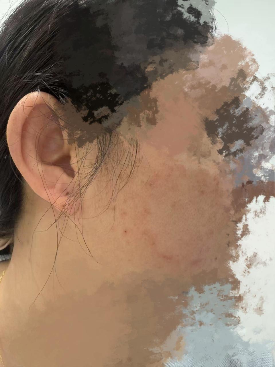 面部出现"怪癣"反复难愈,竟是宠物惹的祸